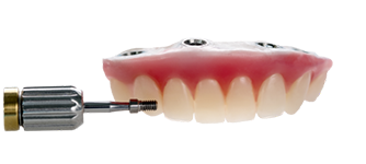 How Do Implant Retained Dentures Work?