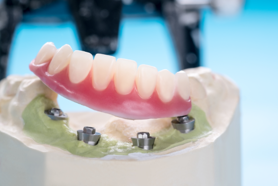 What are Implant-retained Dentures?