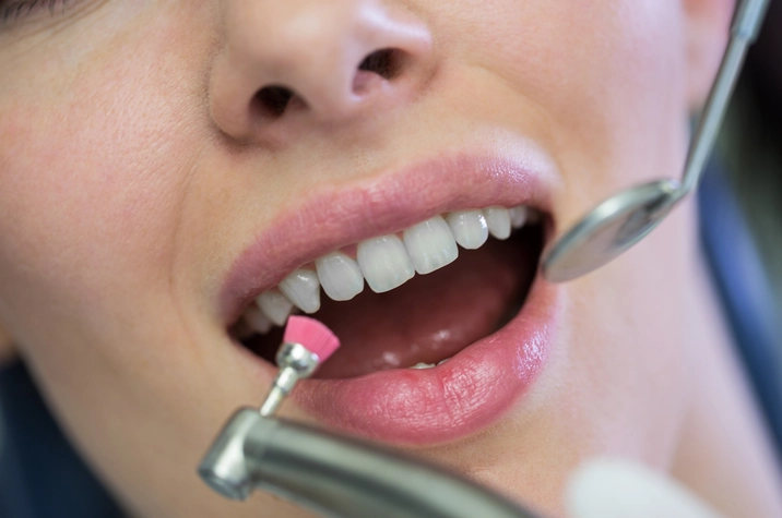 Composite Resin Bonding simi valley