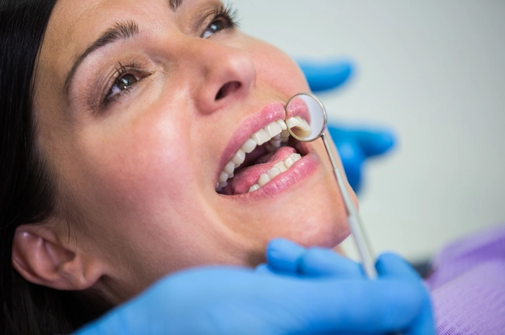 Dental Fillings