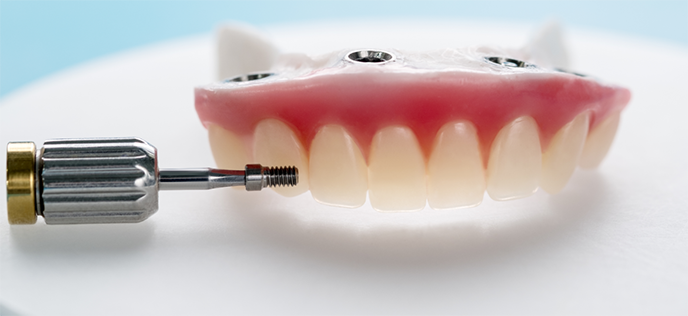 Implant Retained Dentures