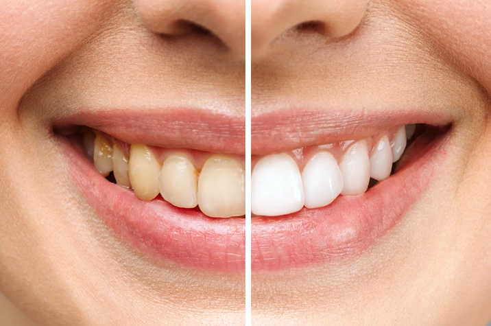 Teeth Whitening