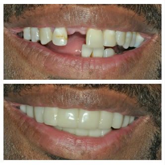 Case 14 Before After Case