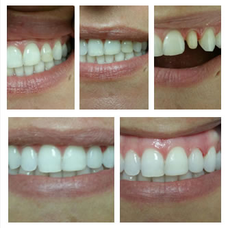 Case 15 Before After Case